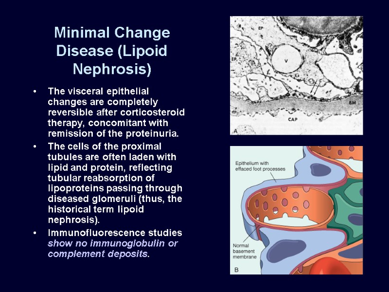 Minimal Change Disease (Lipoid Nephrosis) The visceral epithelial changes are completely reversible after corticosteroid